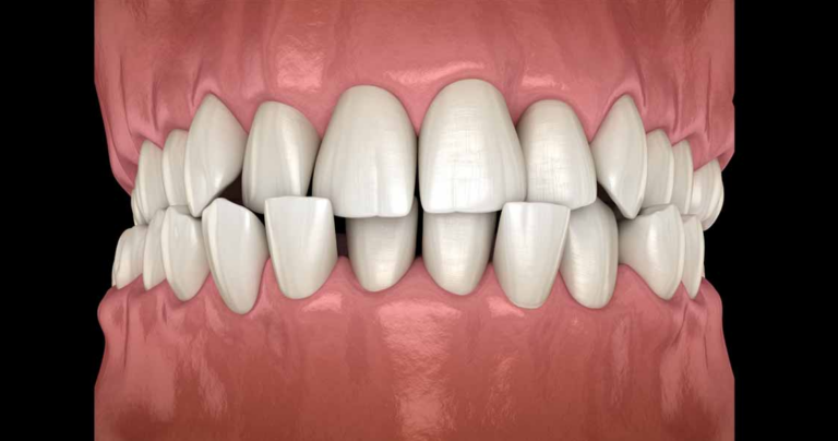 Zgryz krzyżowy wpływa na zdrowie zębów i stawów. Dowiedz się, jak klinika stomatologiczna stosuje aparaty i zabiegi dla trwałego efektu.