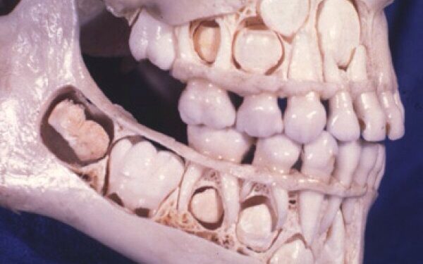 Chronologia wyrzynania zębów – jaka jest kolejność i czas pojawiania się zębów mlecznych , stałych oraz znaczenie diagnostyczne?