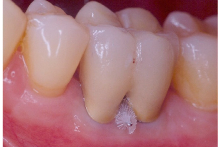 Czym jest furkacja? Poznaj definicję, rodzaje i znaczenie furkacji w leczeniu przyzębia oraz w planowaniu zabiegów w klinice.
