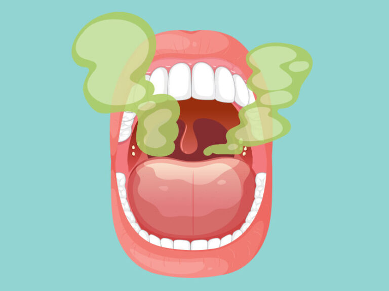 Halitoza to przewlekły lub okresowy nieprzyjemny zapach z ust. Powstaje najczęściej w wyniku rozkładu resztek pokarmowych przez bakterie beztlenowe.