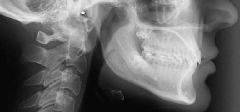 Poznaj cefalometrię – metodę diagnostyczną w stomatologii, która wspiera leczenie ortodontyczne, implanty i kontrolę higienizacji zębów.