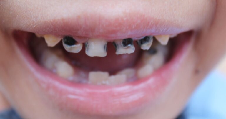 Lapisowanie zatrzymuje próchnicę bez wiertła. Zobacz, jak stomatolog przeprowadza zabieg i dba o bezpieczeństwo pacjenta.