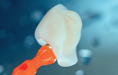 Czym jest adhezja stomatologiczna? Poznaj mechanizm wiązania, zastosowanie w klinice i wpływ na trwałość wypełnień.