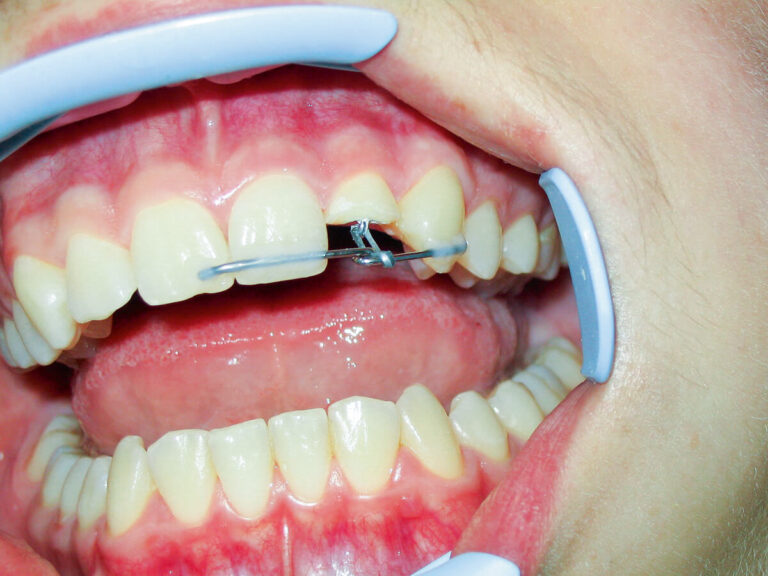 Ekstruzja to wysuwanie zęba z zębodołu, które zaburza zgryz. Sprawdź, jak stomatolog w klinice diagnozuje i leczy ekstruzję.