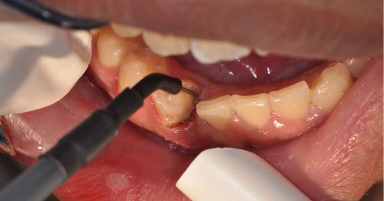 Elektrokoagulacja w stomatologii pozwala zahamować krwawienie i precyzyjnie modelować tkanki miękkie. Sprawdź, kiedy się ją stosuje.