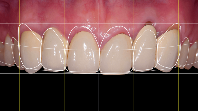 Girlanda dziąsłowa to anatomiczna linia brzegu dziąseł, która wpływa na estetykę uśmiechu i zdrowie przyzębia.