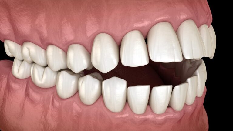 Zgryz otwarty to wada powodująca brak kontaktu zębów. Sprawdź przyczyny i możliwości leczenia ortodontycznego.