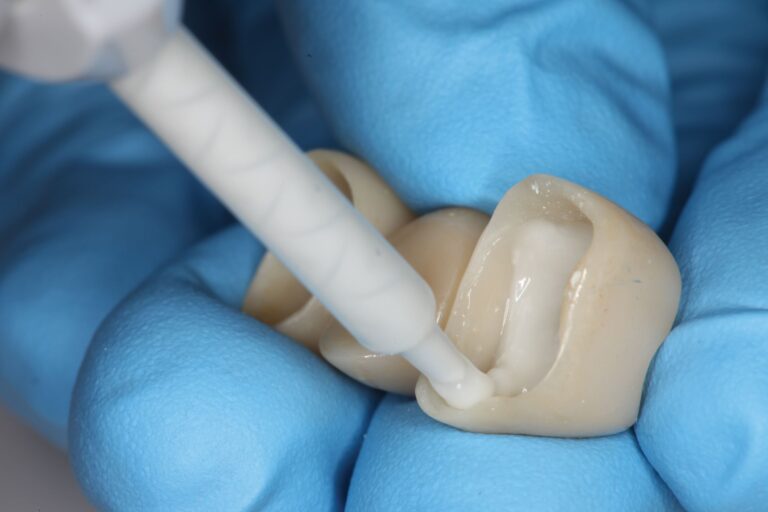 Cement glasjonomerowy zapewnia trwałe wiązanie z zębem i uwalnianie fluoru. Sprawdź zastosowanie w klinice stomatologicznej.