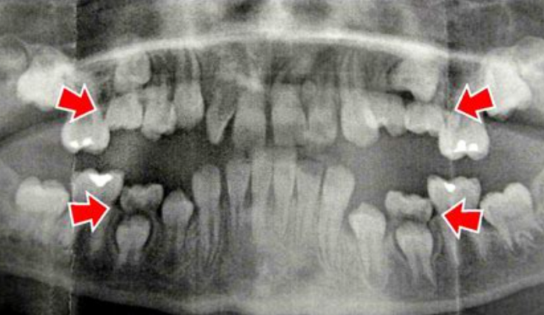 Ząb zrośnięty z kością? Ankylozowanie to unieruchomienie go w kości – dowiedz się, kiedy jakie zabiegli zaleca stomatolog w tym przypadku