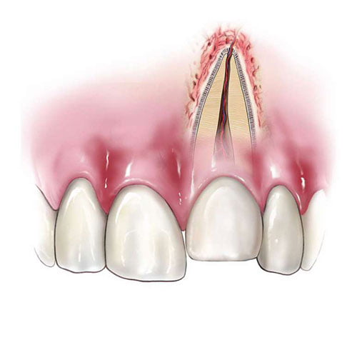 Intruzja to przemieszczenie zęba w głąb kości. Sprawdź, jak stomatolog w klinice diagnozuje i leczy intruzję ortodontyczną.