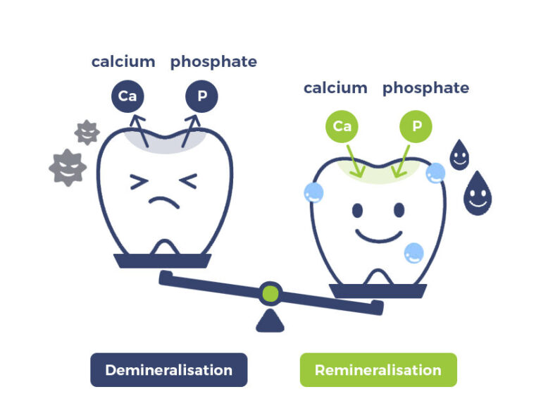 Remineralizacja w klinice dentystycznej to skuteczna ochrona szkliwa. Dowiedz się, kiedy warto ją wykonać.