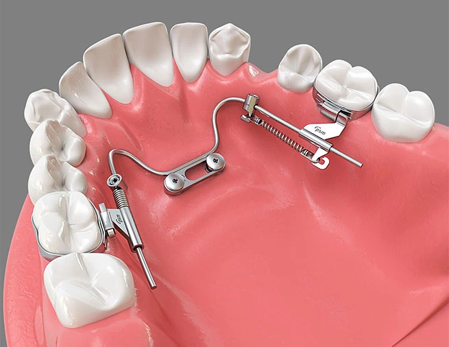 Dystalizacja to przesuwanie zębów ku tyłowi łuku zębowego. Sprawdź, jak stomatolog w klinice wykorzystuje ją w leczeniu zgryzu.