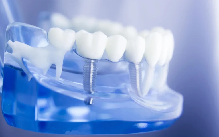 Osteointegracja to kluczowy proces łączenia implantu z kością. Sprawdź, jak stomatolog w klinice dba o trwałość implantów.