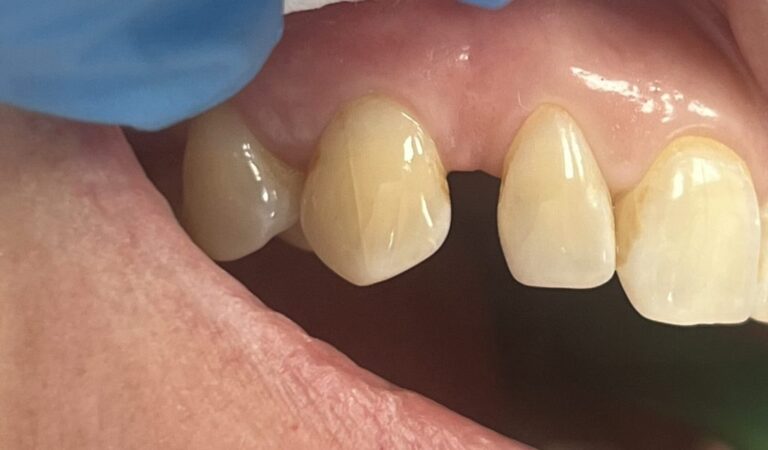 Tremata – szpary między zębami innymi niż jedynki. Sprawdź przyczyny, leczenie i możliwości zamknięcia przerw w klinice stomatologicznej.