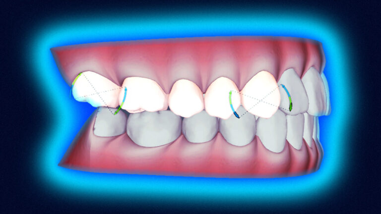 Nieprawidłowa angulacja może powodować przeciążenia zębów i stawów. Zobacz, jak ją ocenia stomatolog w klinice.