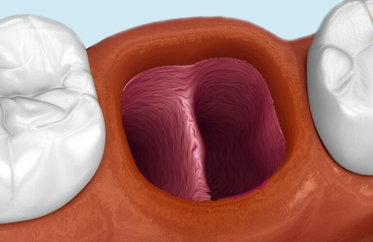Resorpcja kości wyrostka zębodołowego to częsty problem po utracie zęba. Sprawdź jej znaczenie w leczeniu implantologicznym.