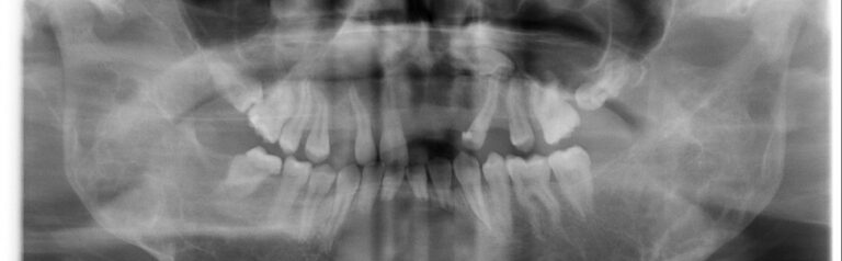 Cherubizm to rzadka choroba genetyczna kości twarzoczaszki. Sprawdź objawy i możliwości leczenia w klinice.