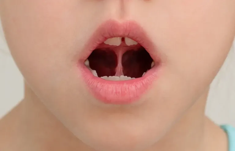 Frenektomia to zabieg korekty wędzidełka wargi lub języka. Sprawdź wskazania, przebieg i znaczenie w leczeniu ortodontycznym.