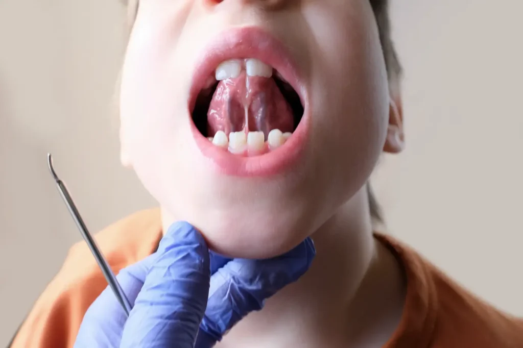 Wędzidełko to fałd błony śluzowej w jamie ustnej. Sprawdź jego funkcję, rodzaje oraz znaczenie w stomatologii i ortodoncji.