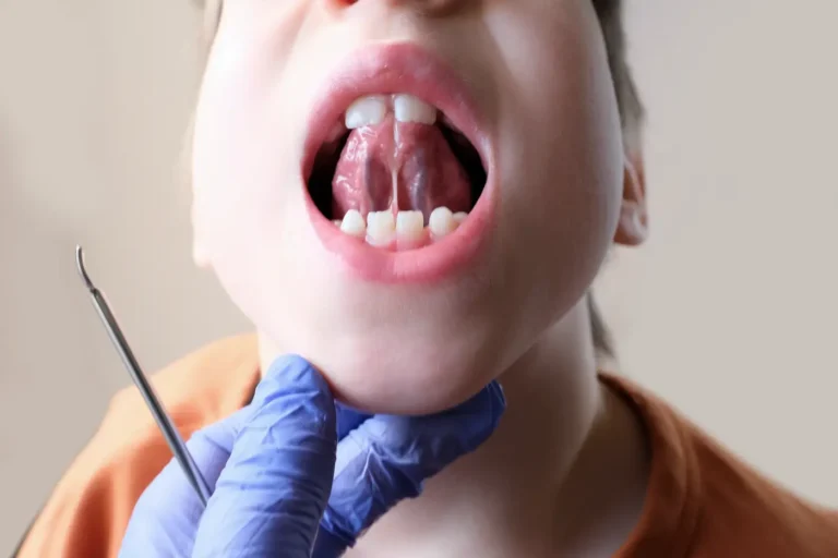 Wędzidełko to fałd błony śluzowej w jamie ustnej. Sprawdź jego funkcję, rodzaje oraz znaczenie w stomatologii i ortodoncji.