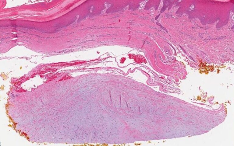 Fibroblastoma to łagodny nowotwór tkanki łącznej w jamie ustnej. Sprawdź objawy, diagnostykę oraz skuteczne metody leczenia tej zmiany.