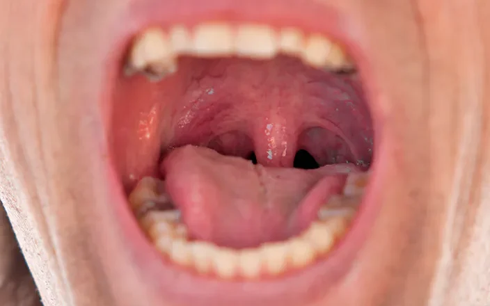 Jatrogenia stomatologiczna to powikłania po leczeniu zębów. Sprawdź przyczyny, objawy oraz sposoby zapobiegania i leczenia.