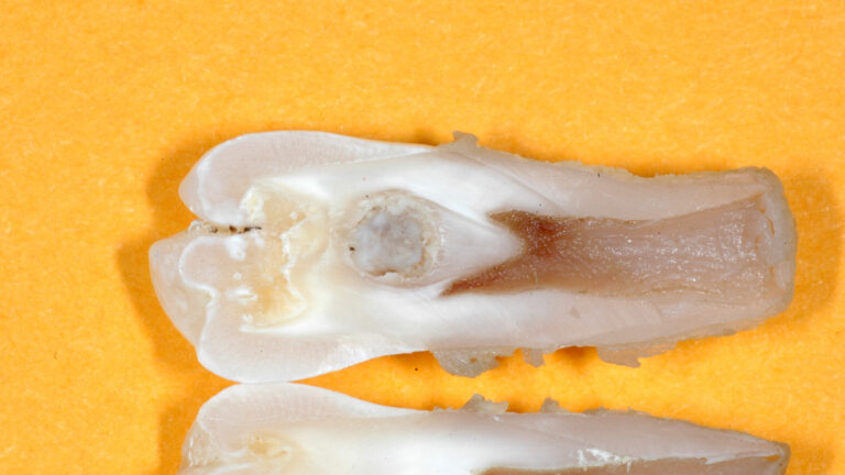 Dens invaginatus czyli inaczej „ząb w zębie”, która wymaga korekcji. Sprawdź objawy, przyczyny oraz metody leczenia i profilaktyki.