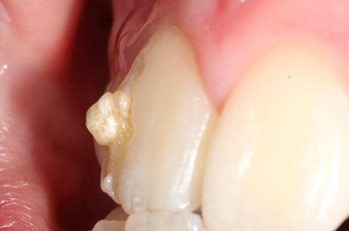 Dens evaginatus to wada z dodatkowym guzkiem na zębie. Sprawdź objawy, przyczyny oraz metody leczenia i profilaktyki.