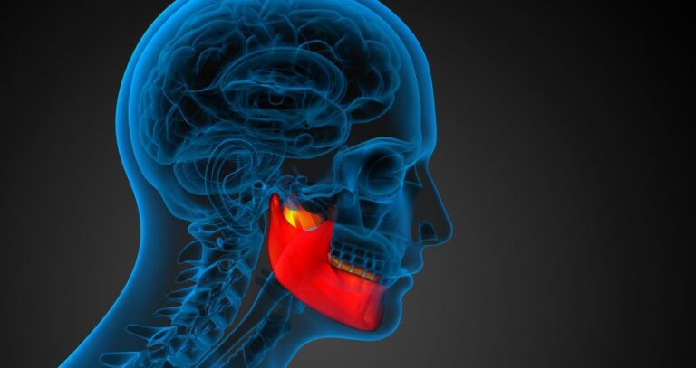 Nekroza kości szczęki to poważne schorzenie prowadzące do obumarcia tkanki kostnej. Sprawdź objawy, przyczyny i leczenie.