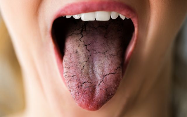 Zespół Sjögrena powoduje suchość jamy ustnej i zwiększa ryzyko próchnicy. Sprawdź objawy, przyczyny i leczenie choroby.