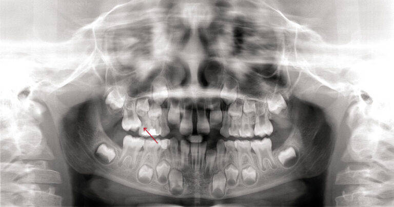Wyrzynanie ektopowe to nieprawidłowe pojawienie się zęba w łuku. Sprawdź przyczyny, objawy i leczenie ortodontyczne.