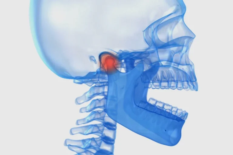 Kapsulotomia stawu skroniowo-żuchwowego to zabieg poprawiający ruchomość żuchwy. Sprawdź wskazania i przebieg leczenia.