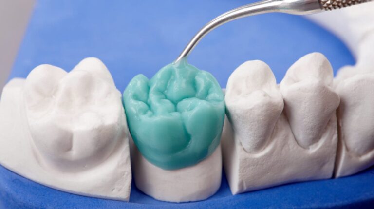 Wosk diagnostyczny, znany też jako dentystyczny, pomaga w planowaniu leczenia protetycznego i estetycznego zębów. Dowiedz się więcej.