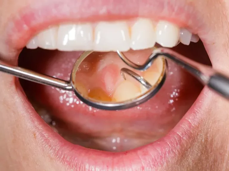 Sondy periodontologiczne służą do oceny stanu dziąseł i przyzębia. Sprawdź ich zastosowanie oraz rodzaje.